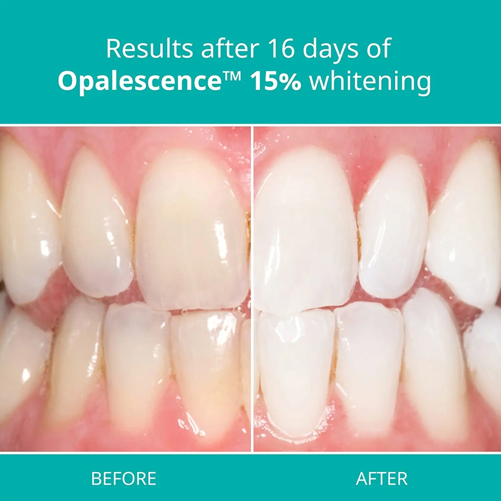 Opalescence Kit de blanqueamie - Teeth Whitening Gel Refills reseña y precio
