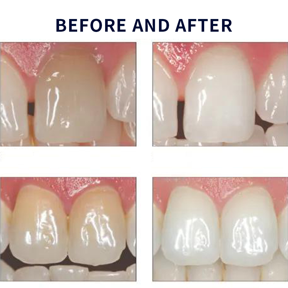 Opalescencia blanqueadora 20%  - Teeth Whitening Gels Used By Dentists reseña y precio