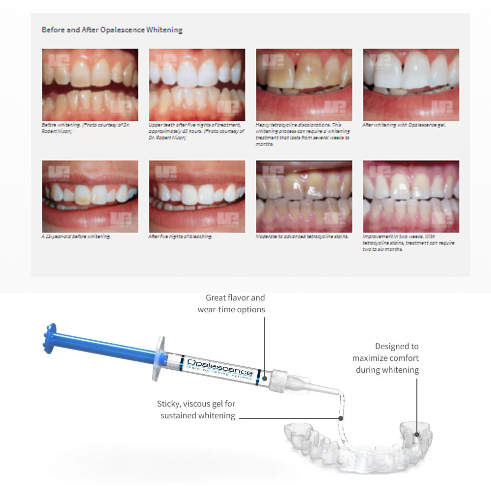 Opalescencia blanqueadora 20%  - Teeth Whitening Gels Used By Dentists reseña y precio